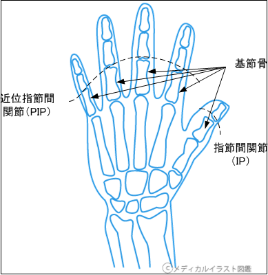 指の欠損