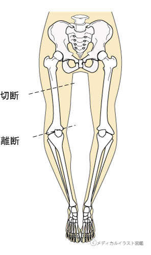 下肢切断