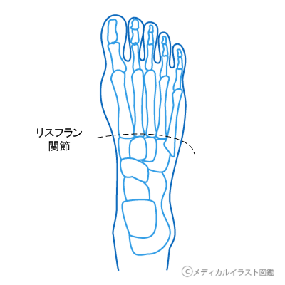 リスフラン関節切断