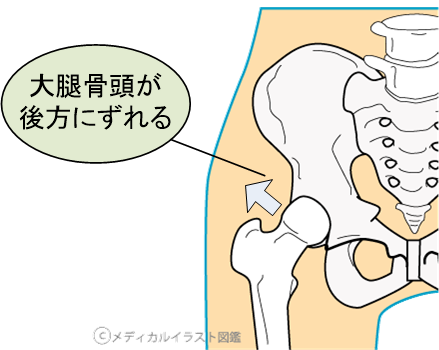 股関節脱臼